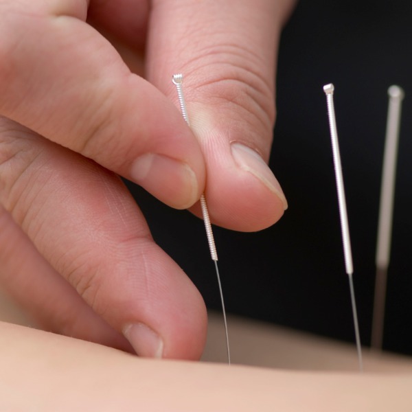 Akupunktur Traditionelle Chinesischen Medizin TCM